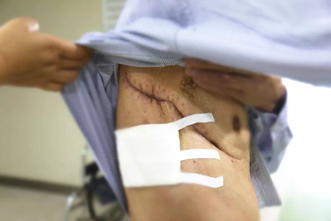 "再也不怕伤口弄脏衣服了"刘主任说,脓胸大多数为继发性的,胸部手术