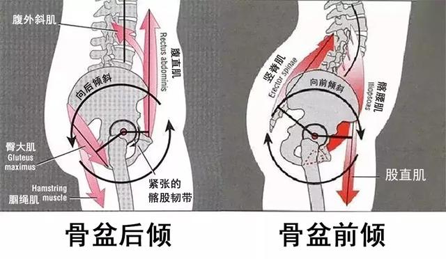 骨盆前倾和骨盆后倾图图片