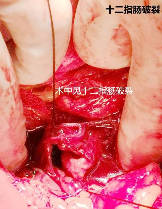 医院普外科应用"损伤控制外科理念"成功抢救重度十二指肠破裂患者生命