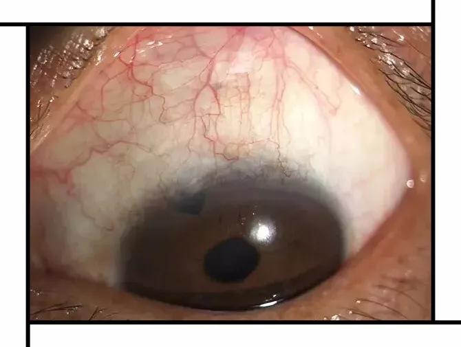 叮咚您有一份关于青光眼术后症状的全解指南