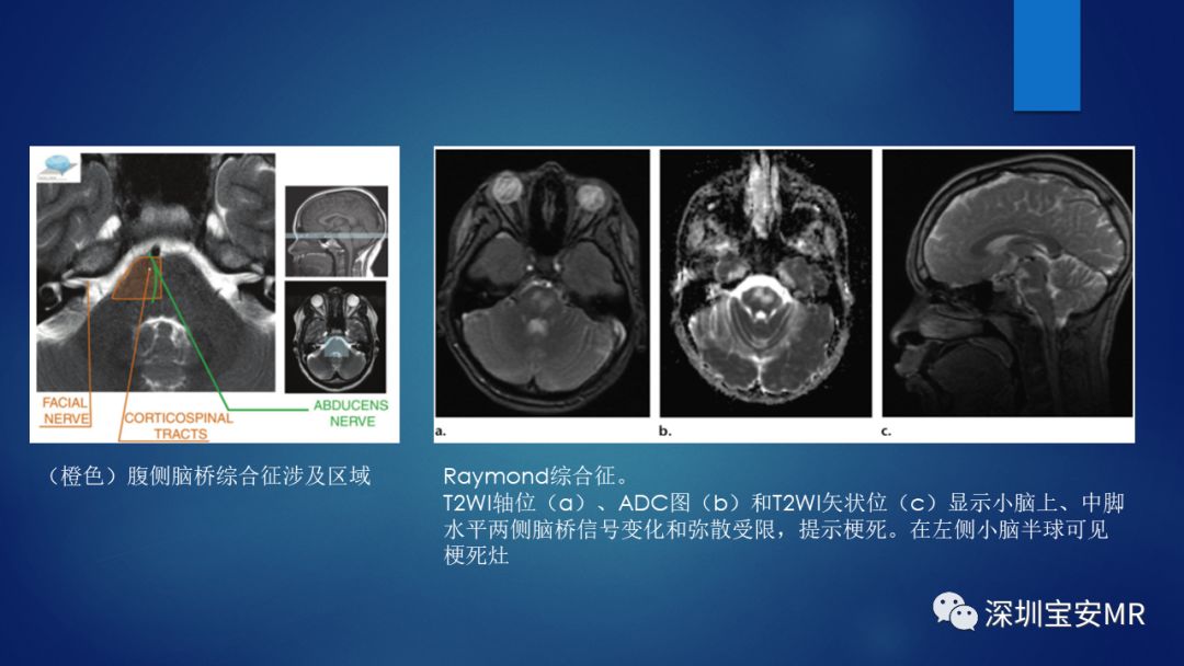 中脑脑桥及延髓解剖和综合征
