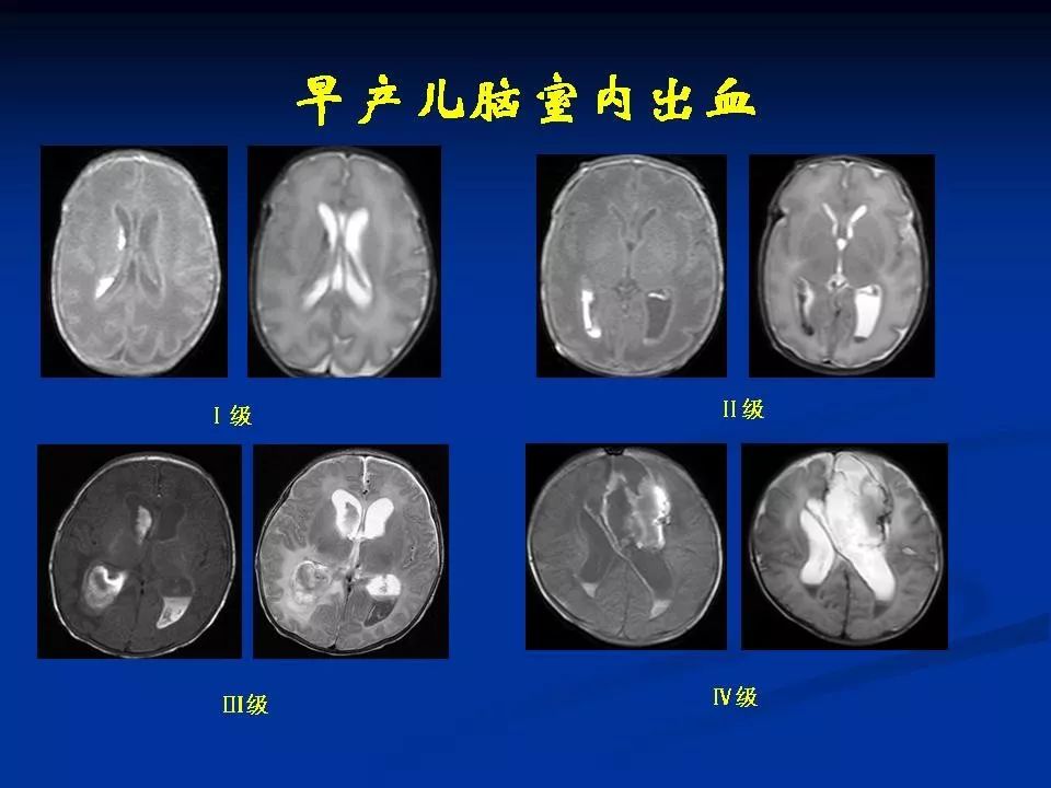 新生儿颅脑mri解剖及常见疾病67三影像天地