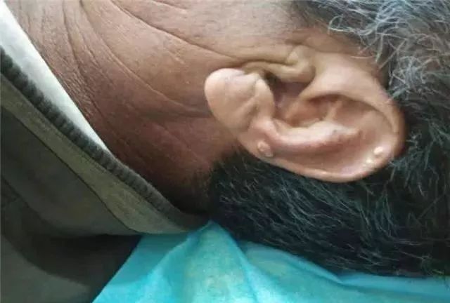 会出现小结节的现象,常见的部位就是耳轮,所以耳轮出现结节现象,可能