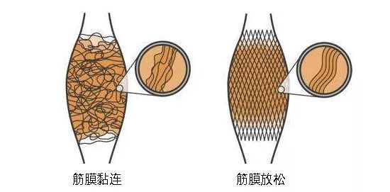 筋膜的弹性就会变差,慢慢地就会越来越紧张,当出现脱水,粘连,挛缩时