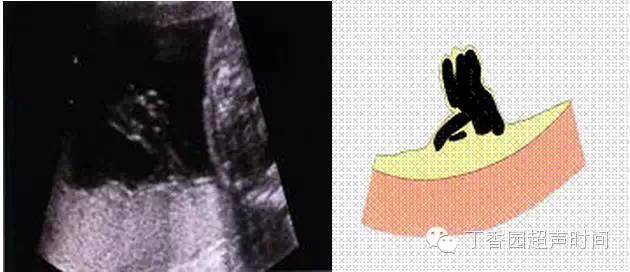 超聲微課堂正常胎兒妊娠中期超聲檢查標準切面