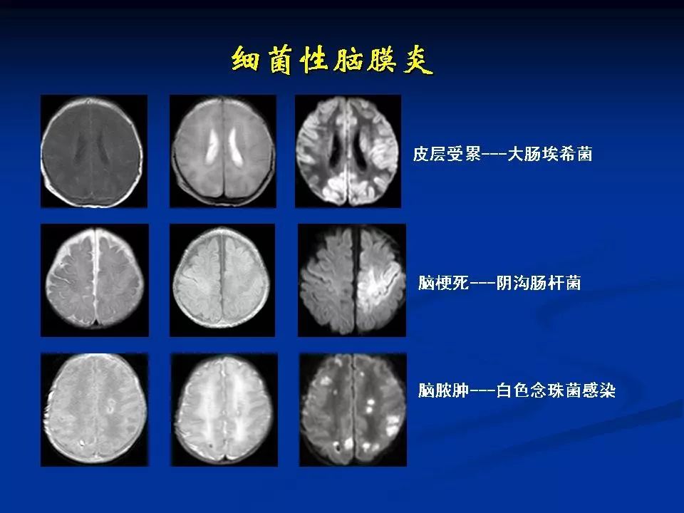 新生儿颅脑mri解剖及常见疾病67三影像天地