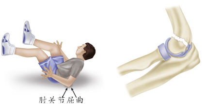 兒童最易出現的骨折肱骨髁上骨折是怎麼回事