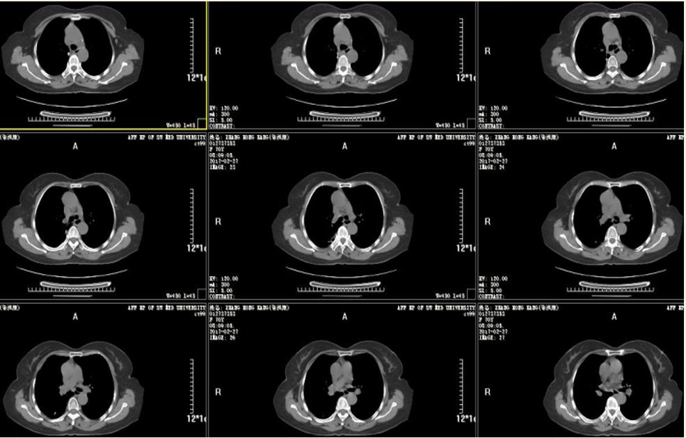 肺癌病例 