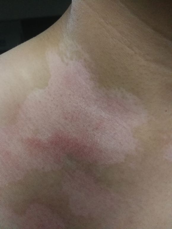 白癜风怎么就突然扩散了_白斑