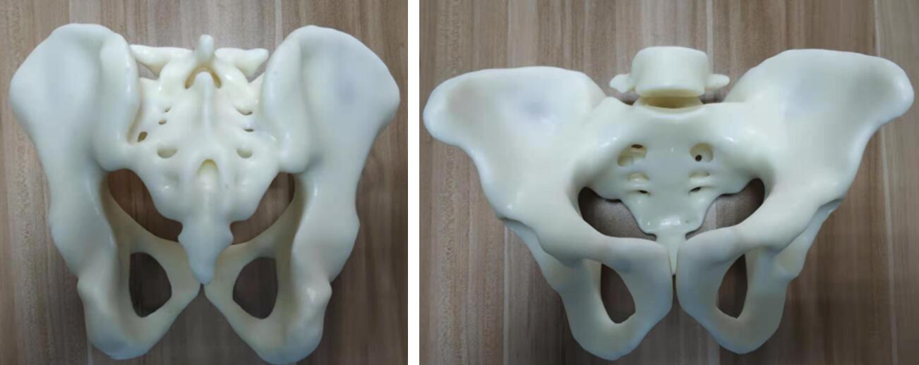 攀枝花三帝科技3d打印助力髋关节患者骨盆修复