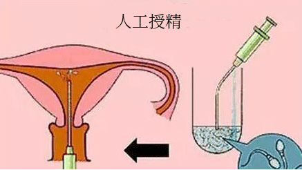 新愿景!什么是人工助孕炙手可热