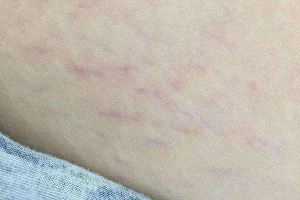 孕期妊娠纹大概什么时候会出现_腹部