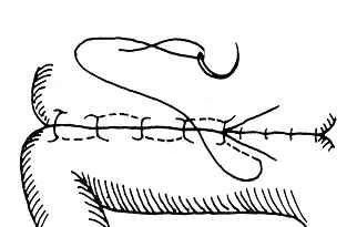 ⑷连续全层水平褥式内翻缝合法