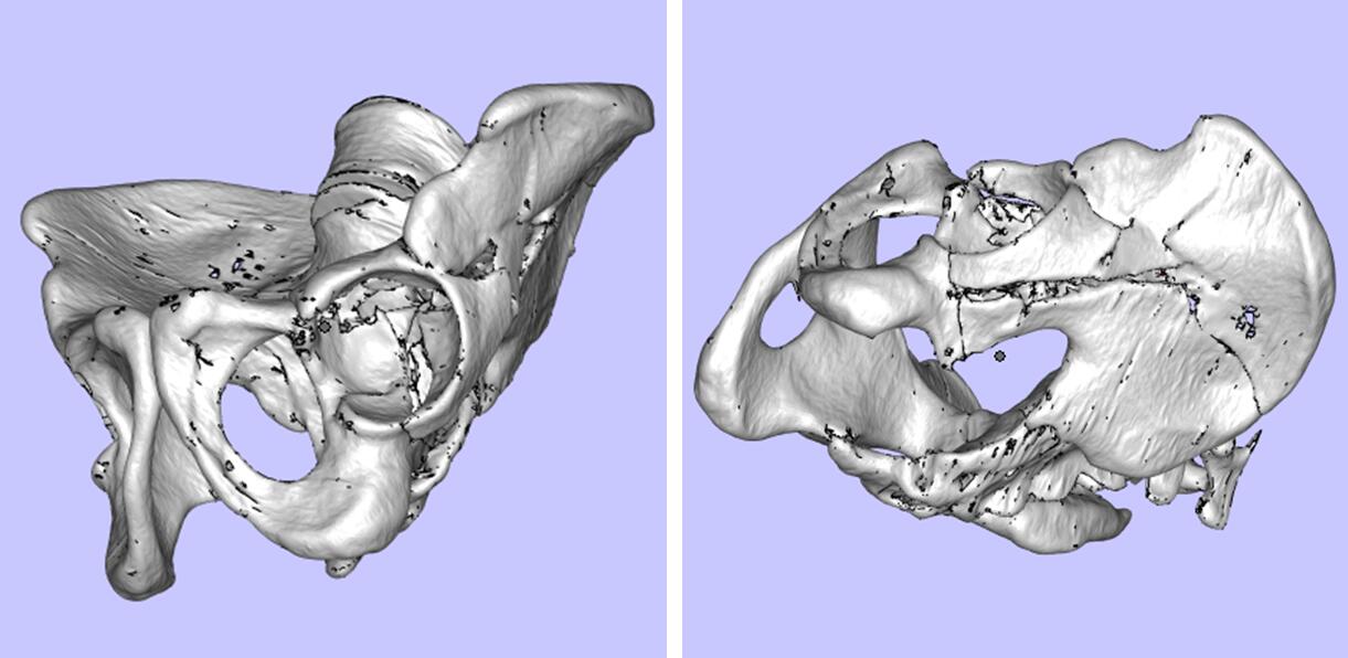 攀枝花三帝科技3d打印助力髋关节患者骨盆修复