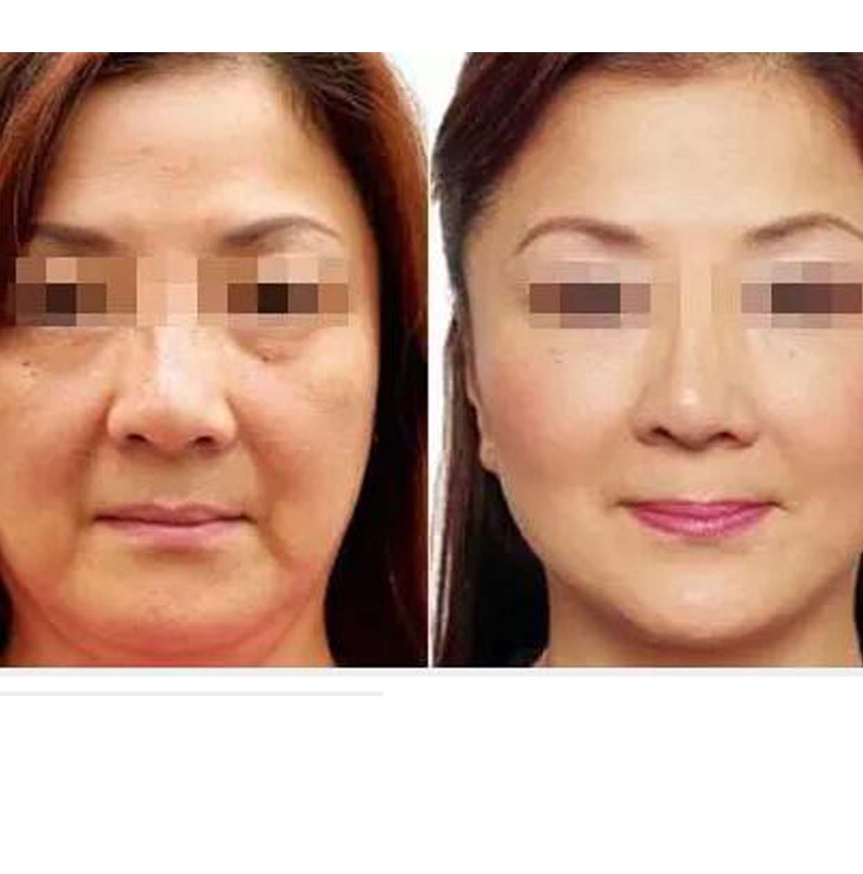 为什么是超声刀有副作用?且听我说