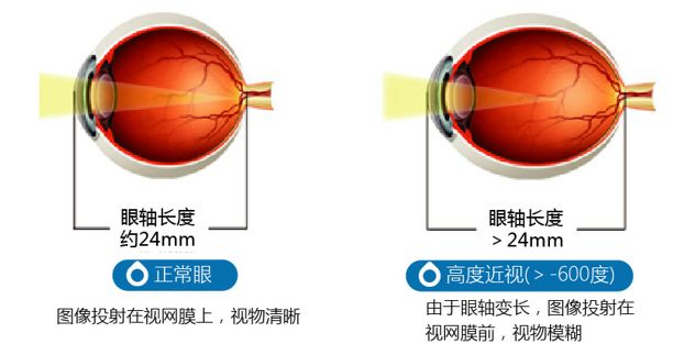 眼轴变化图图片