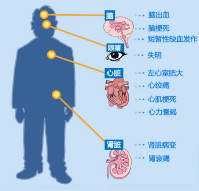 高血压患者打泵药是什么原理_什么是高血压(2)