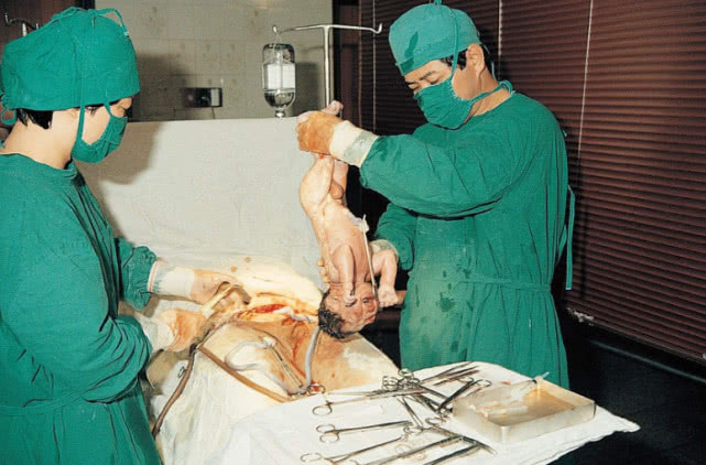 剖腹产手术,为何取出胎儿必须在15分钟内?决定剖腹产的孕妈了解