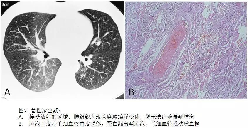 规范诊疗曾昭冲教授精准治疗时代的放射性肺损伤