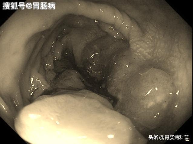 结肠癌晚期图片