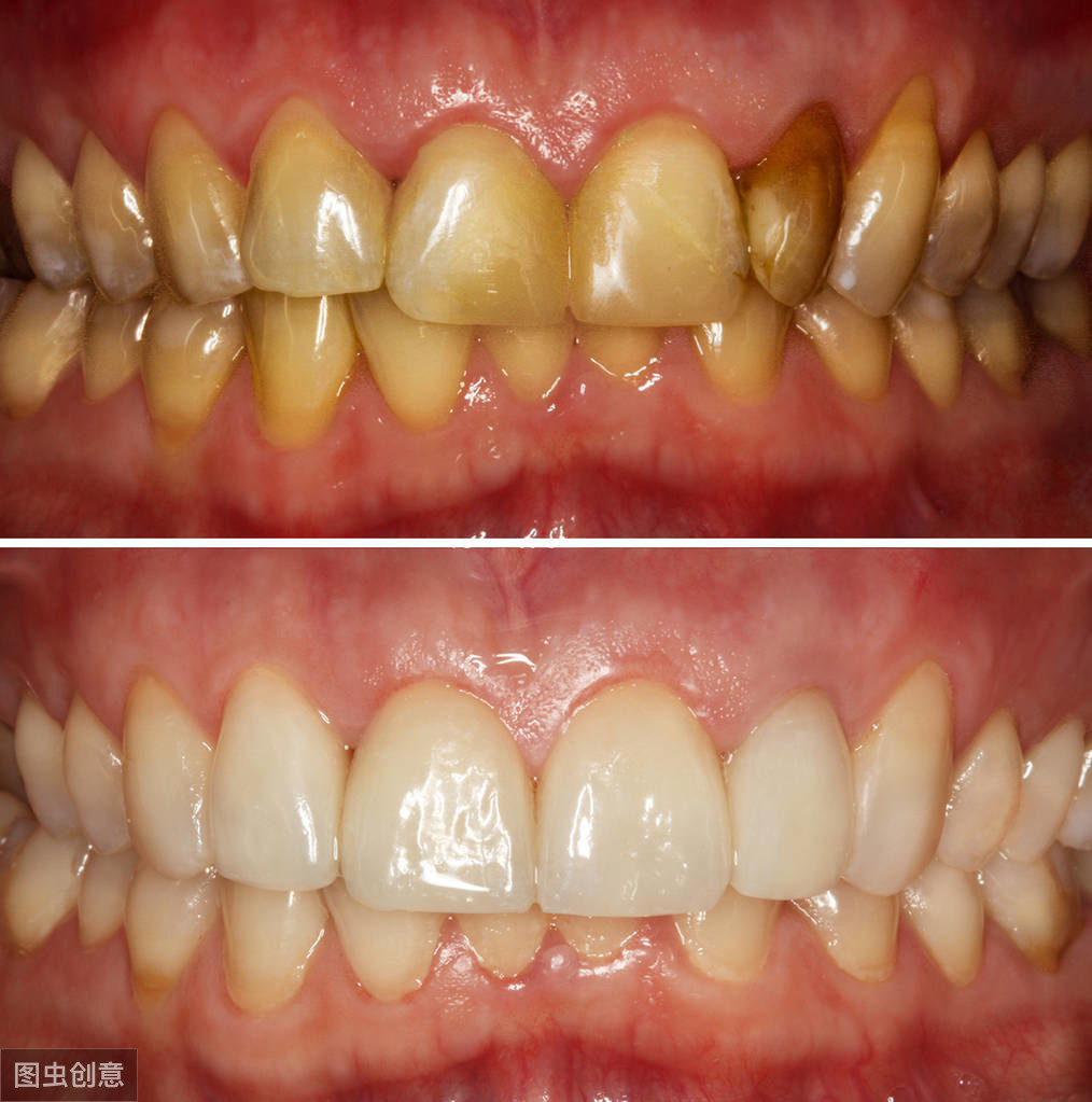 1 容易导致变黄变黑那么吸烟对牙齿具体有哪些危害呢?