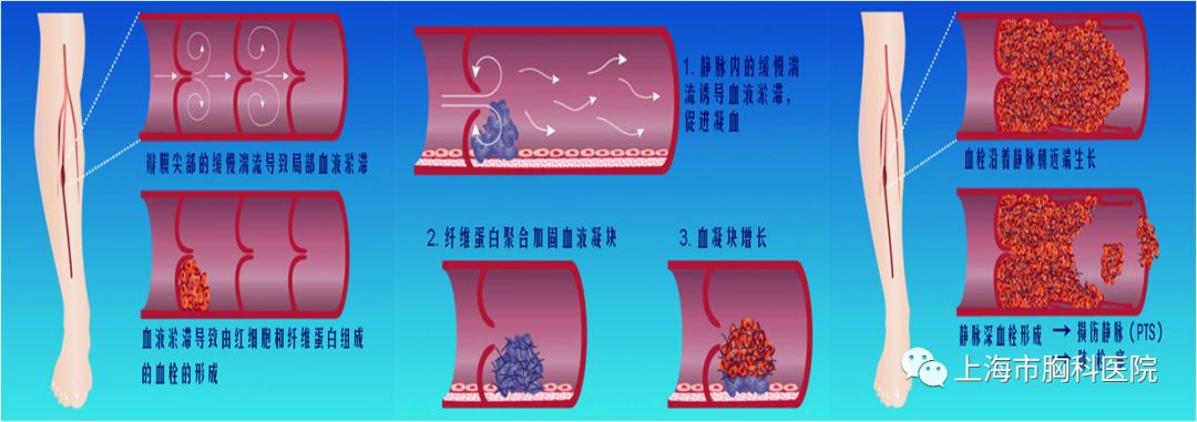 小心静脉血栓栓塞症——我院举行胸科科普小讲堂