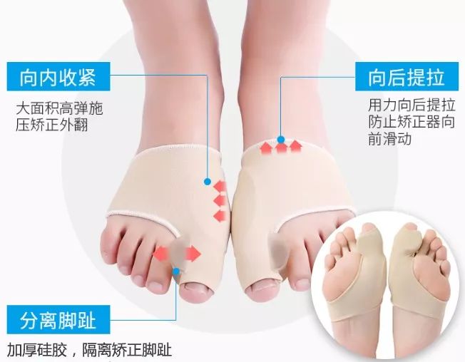 走路疼?用它无痛矫正大脚骨,还你纤纤玉足!