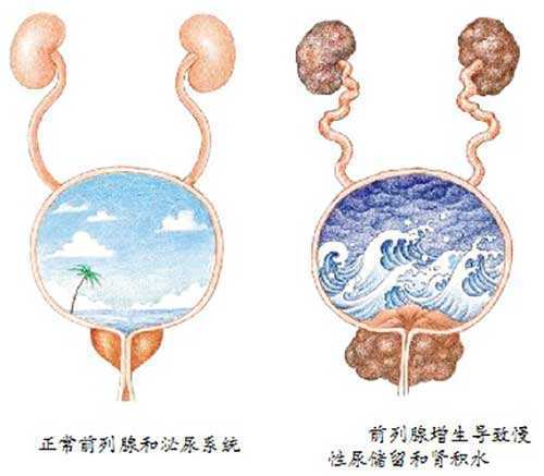 女性前列腺分泌图片