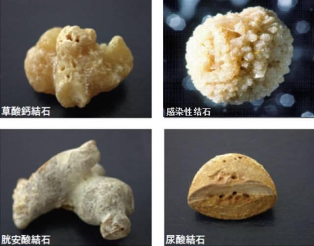 草酸钙结石最常见,还有磷酸盐,尿酸盐,碳酸盐结石,胱氨酸结石罕见