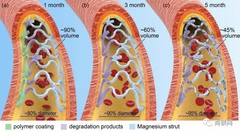 上海交大袁廣銀教授團隊在可降解鎂合金血管支架設計方法研究領域取得