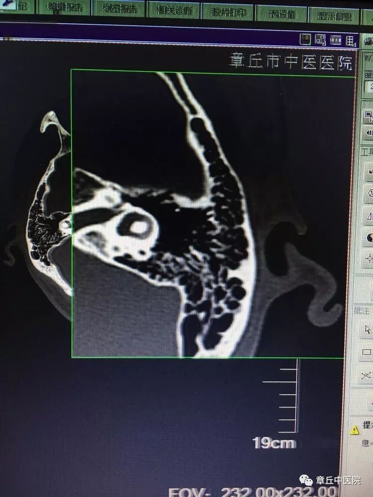 区中医院专家教您辨别耳石症