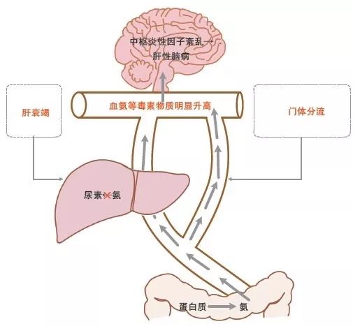 肝性脑病ppt课件插图图片