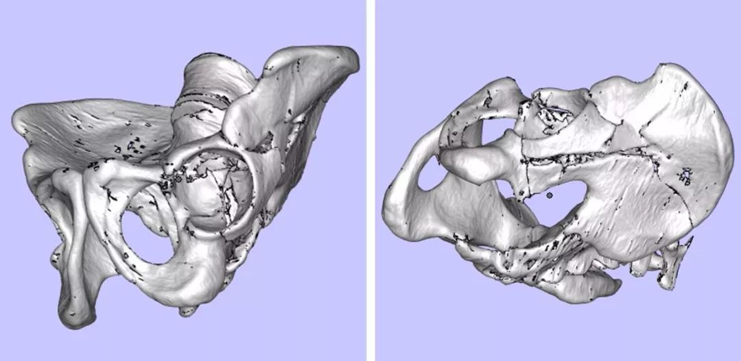 攀枝花三帝科技:3d打印助力髖關節患者骨盆修復_手術