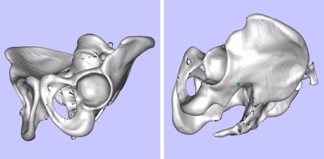 攀枝花三帝科技:3d打印助力髖關節患者骨盆修復_手術