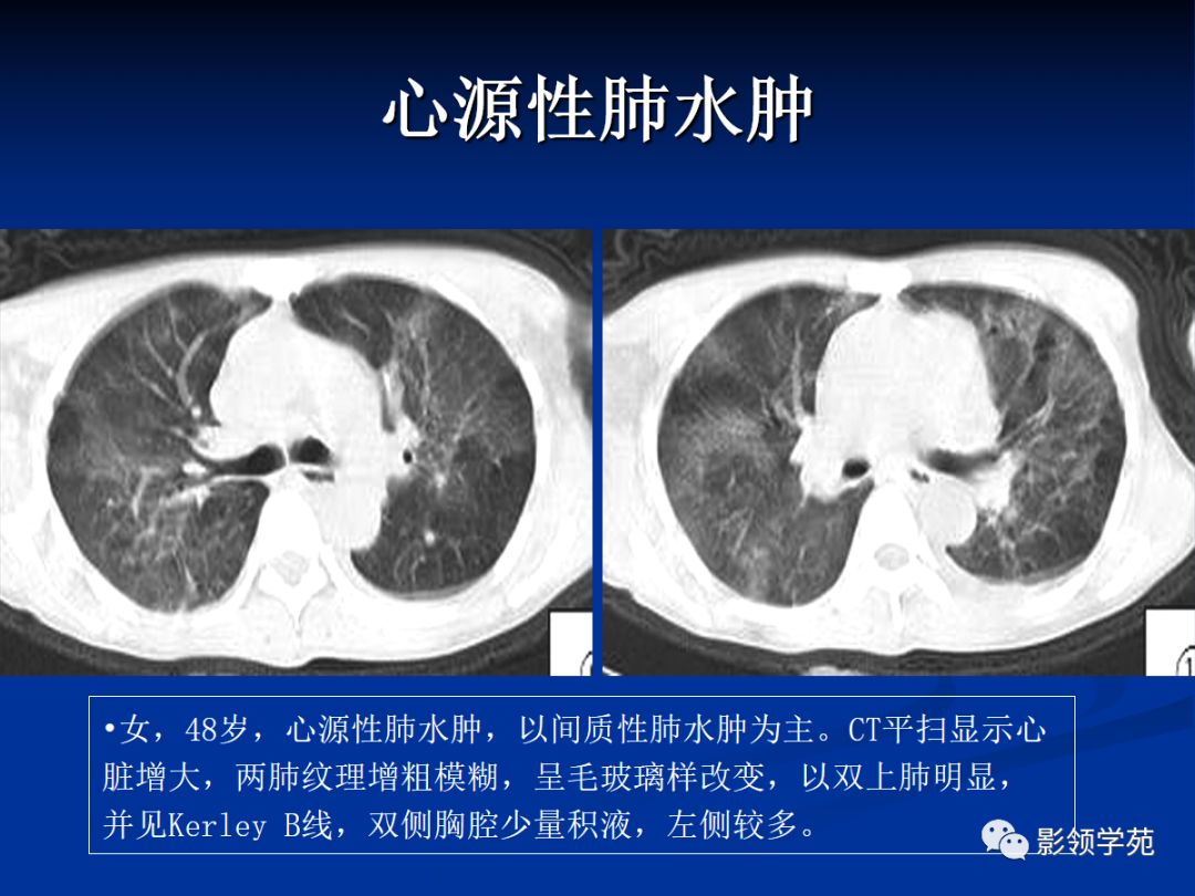 尿毒症肺水肿图片