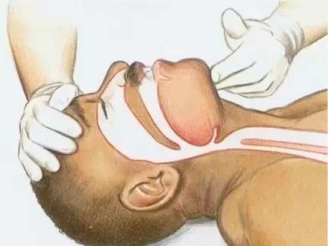 成人,儿童采用口对口婴儿采用口对口鼻一手切住额头,一手抬下颌,与地