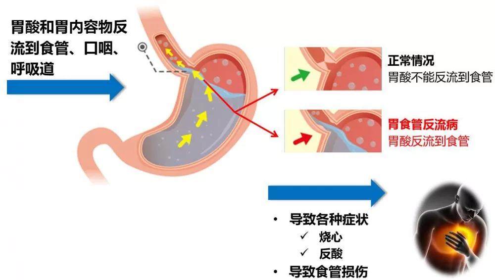 胃部胸口火辣辣,嘴裡經常冒酸水……你可能得了這種病,別輕視,抓緊治_