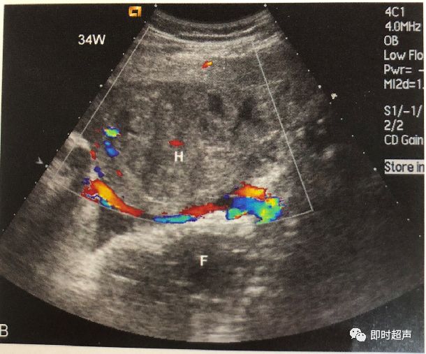 胎盘早剥超声诊断图片