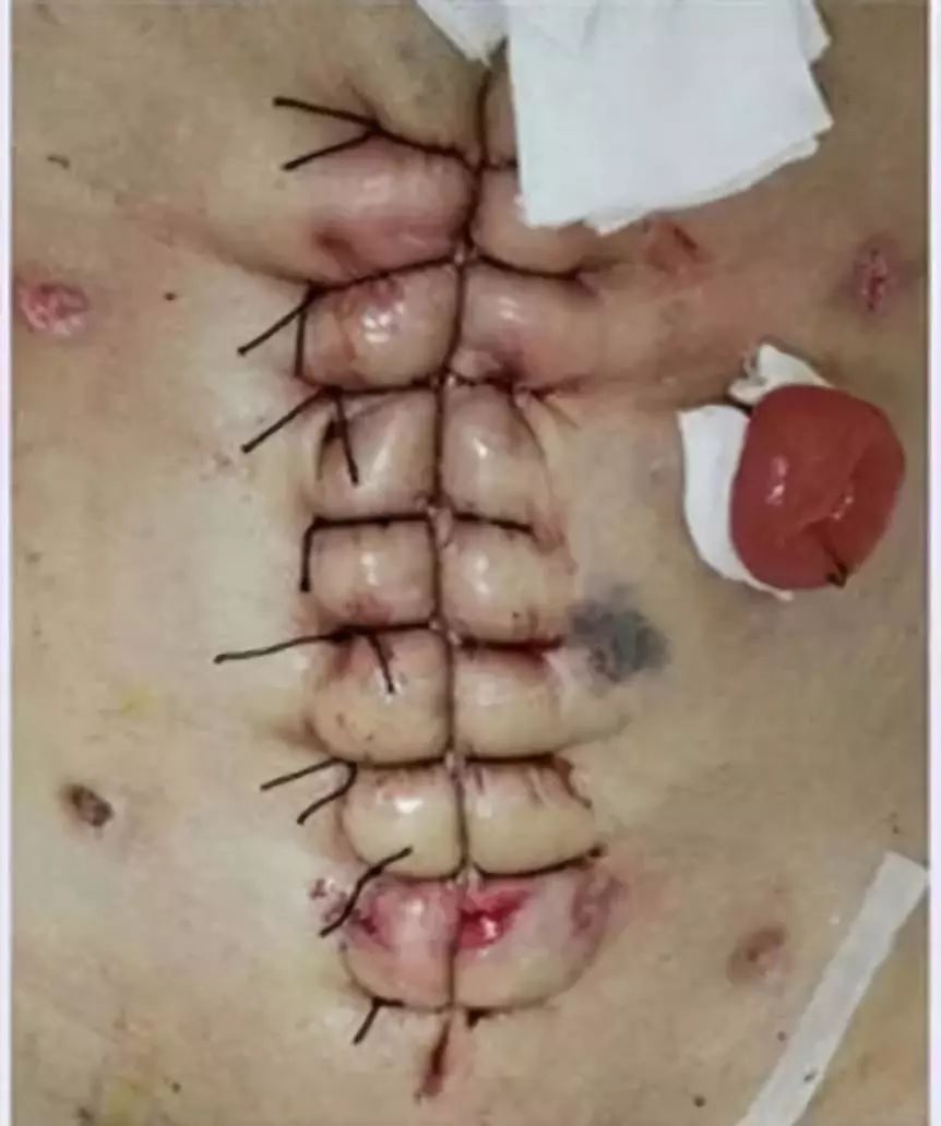胃穿孔手术后图片图片