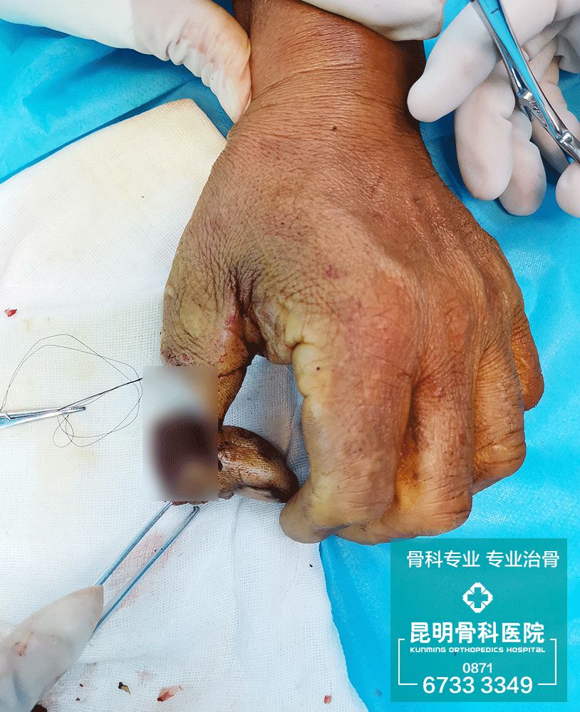 男子断指求医无门昆骨专家断指再植成功