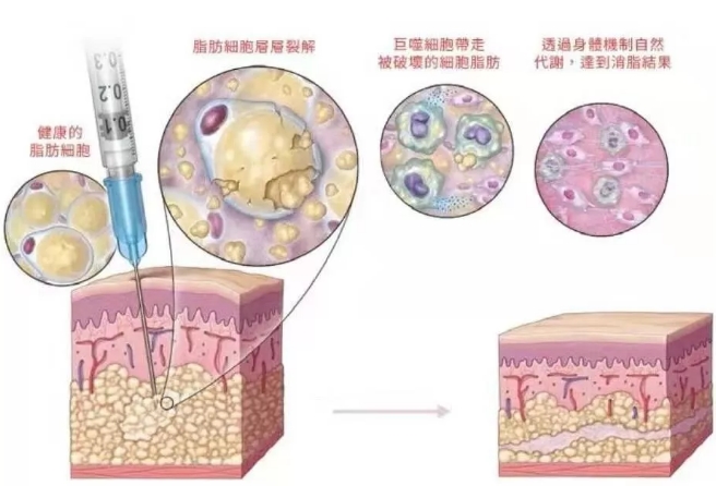 胖妞打溶脂针瘦腿后悔了溶脂针副作用伤不起有必要吗