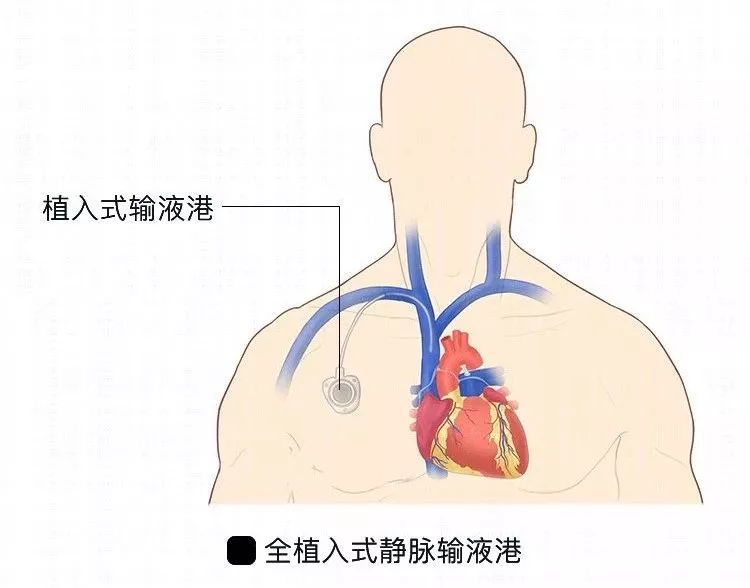 有,输液港——非你莫属!不用每次化疗都置管?