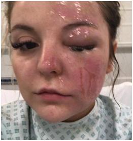 用微波炉煮蛋遭爆炸英女子面部被烧伤眼睛恐永久失明