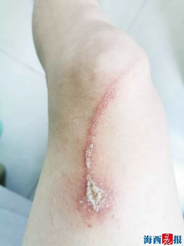 夏天碰到这虫子千万别拍,美女险被"毁容"!厦门也有人"中招"