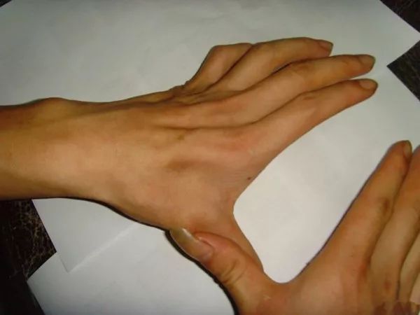 4,进行性延髓麻痹:以逐渐加重的延髓麻痹症状首发,表现为吞咽困难