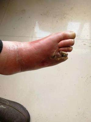我院多学科合作成功救治多例糖尿病足患者