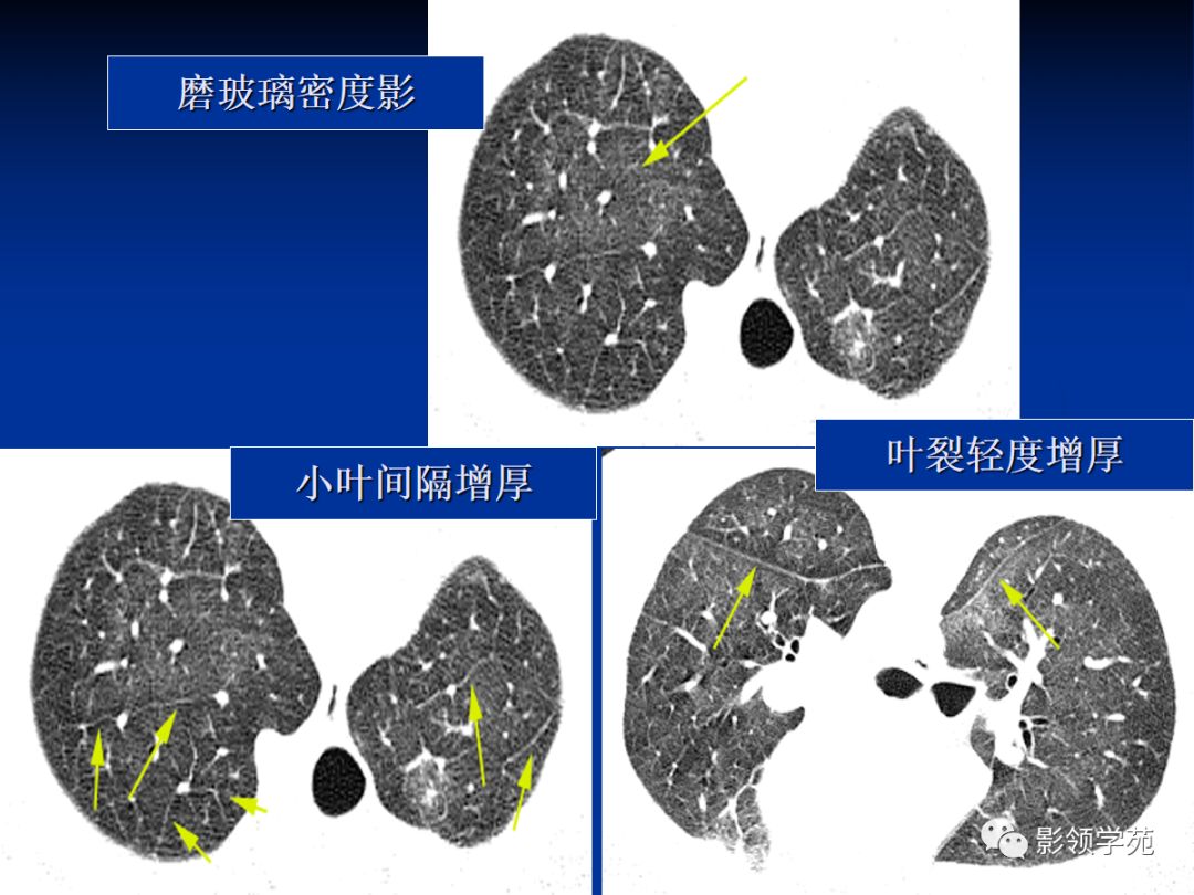 叶间裂水肿图片