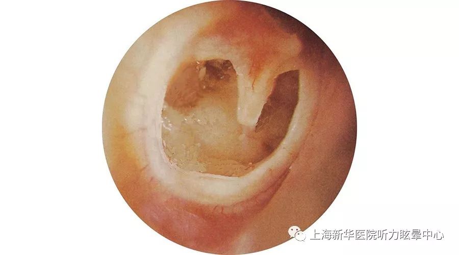 鼓膜穿孔了怎么办,一定要手术修补吗?