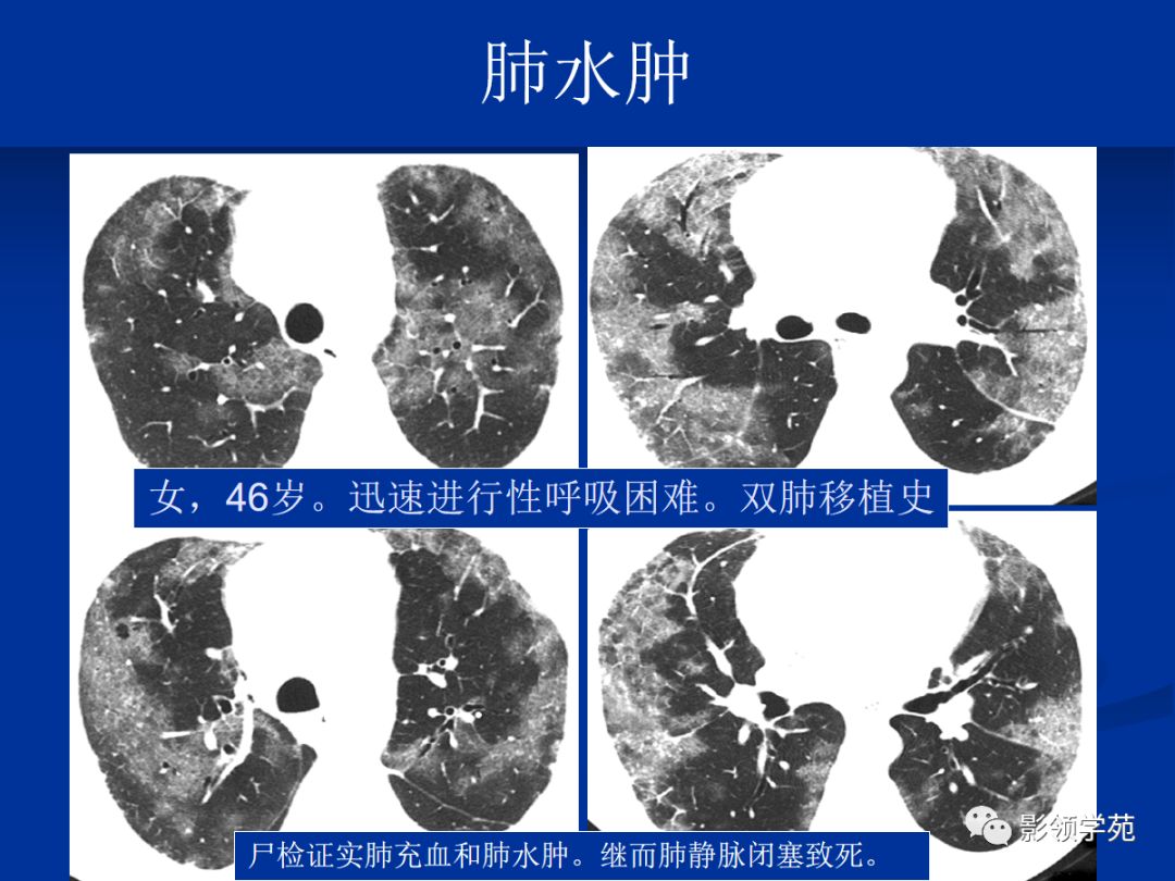 不同类型肺水肿的ct表现