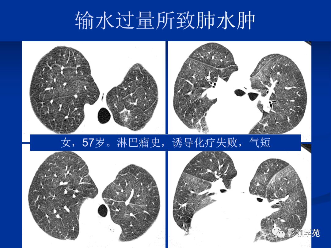 叶间裂水肿图片